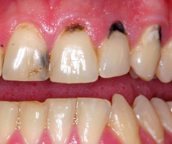 How To Reduce Black Mark On Gums 21