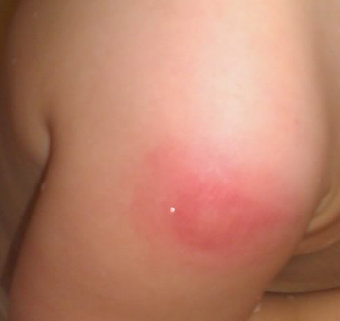 Pictures of Bed Bug Bites - About.com Travel