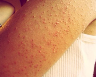 Itchy red bumps all over body? Hives? - Skin conditions ...