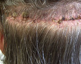 Scalp Problems: Hair Loss, Eczema (Cradle Cap), Dandruff ...