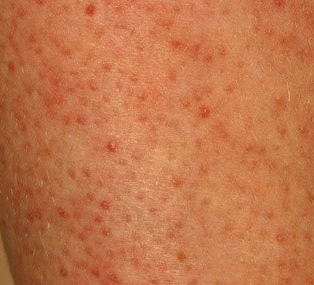Brown Spots on Skin, Causes, Pictures ... - lightskincure