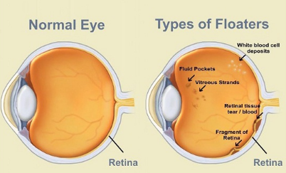 Floaters in the Eye, Causes, Black Spots in Vision, Get Rid, Natural 