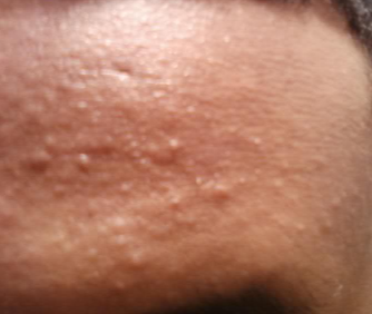 What causes foreheads to break out in small red bumps ...