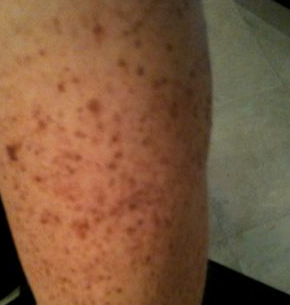 light brown spots on skin - Dermatology - MedHelp