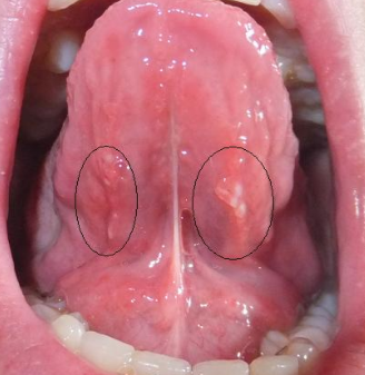 Lump Under Mouth 31