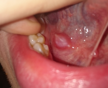 painful white bump on tongue