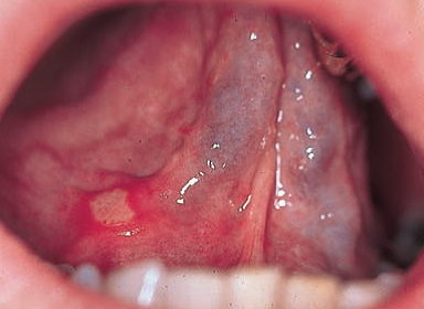 Black Lump In Mouth 47