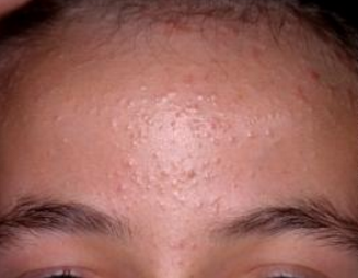 Dermatology Forehead Doctor Answers, Q&A, Tips - RealSelf