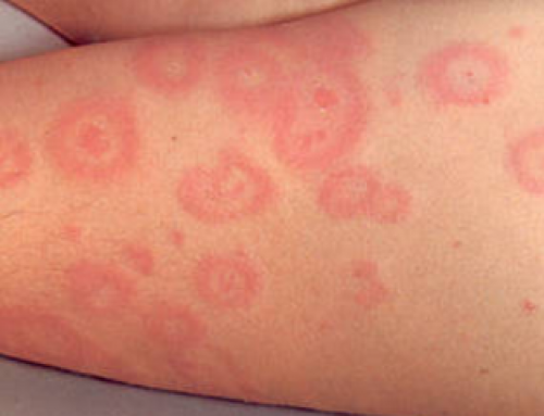 Blood Spots On Skin Red Tiny Raised Itchy Bumps Pictures Causes