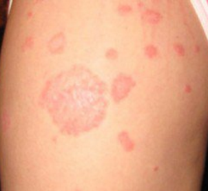 Most Common Types of Itchy Skin Rashes – Dermatology