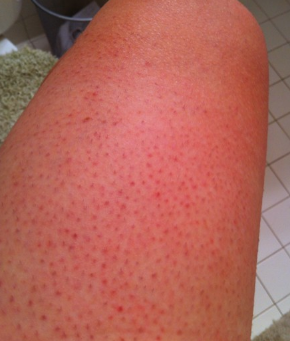Pictures of Red Spots on legs