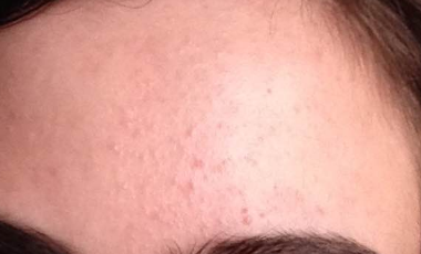 Small Bumps on Face, not Pimples, Acne, Forehead, Rash ...