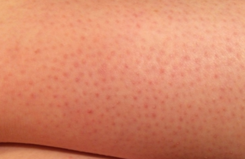 Red Spots on Legs | MedGuidance