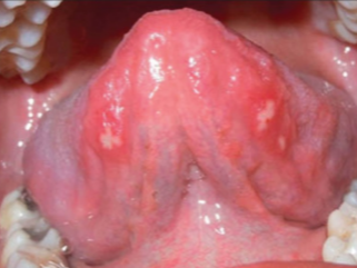 Bumps on Tongue - Diseases Pictures