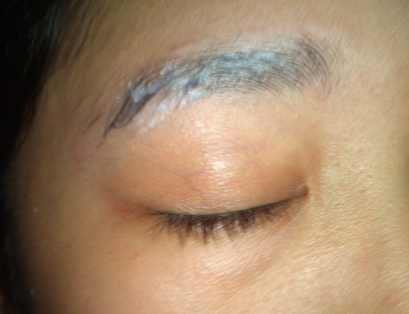 Dry Skin In Eyebrows - Doctor answers on HealthTap