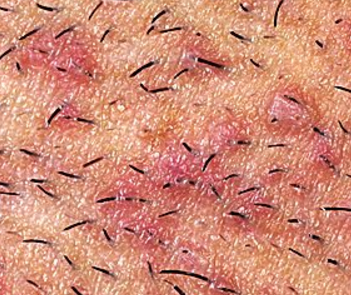 What should someone do about itchy skin after shaving?
